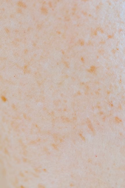 Bőrdiagnosztikai vizsgálat közelről
